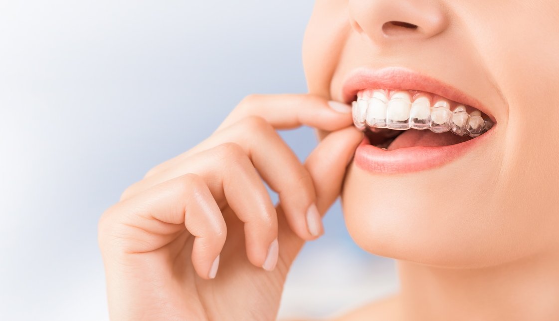 A young woman applying clear ortho aligners.